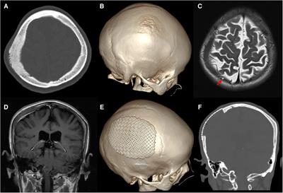 Primary intraosseous meningioma with subcutaneous and dural invasion: A case report and literature review